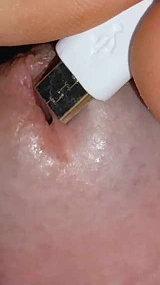 Electrical Introduction Into the Glans Opening.